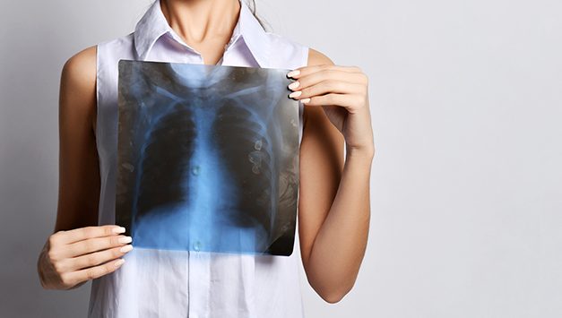 Redakan Gejala Bronkitis Dengan 5 Pengobatan Alami Ini