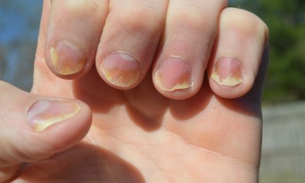 5 Tanda Kuku Yang Bisa Menunjukkan Kondisi Kesehatan Organ