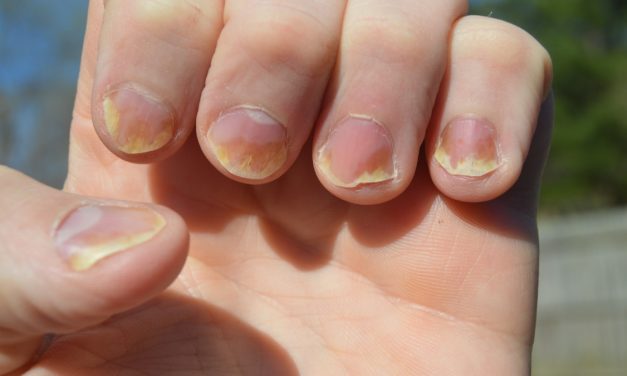 5 Tanda Kuku Yang Bisa Menunjukkan Kondisi Kesehatan Organ